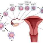 子宫肌瘤：症状与治疗指南